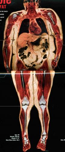mri-fat.jpg